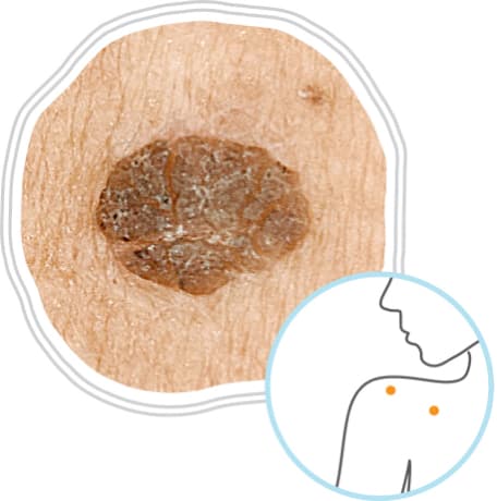 Queratosis seborreica