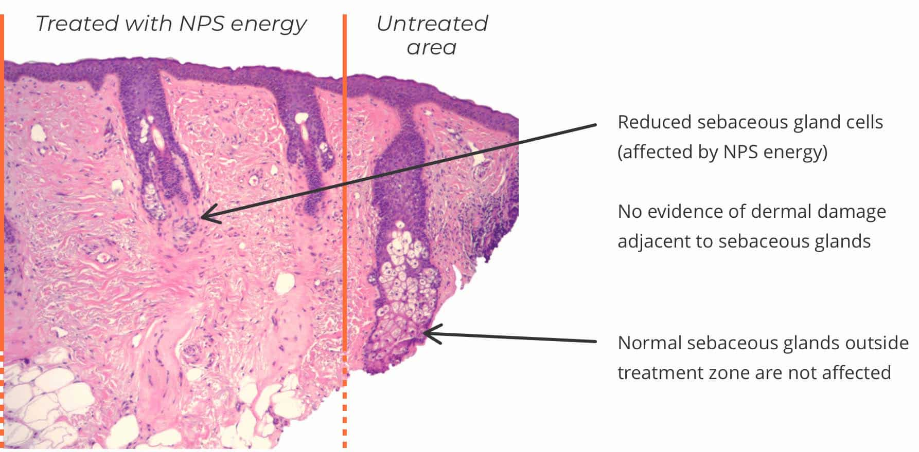 Treatment Zone