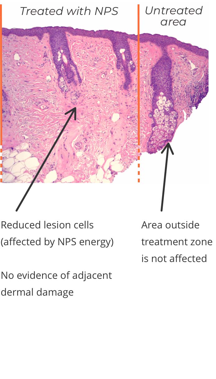 Treatment Zone