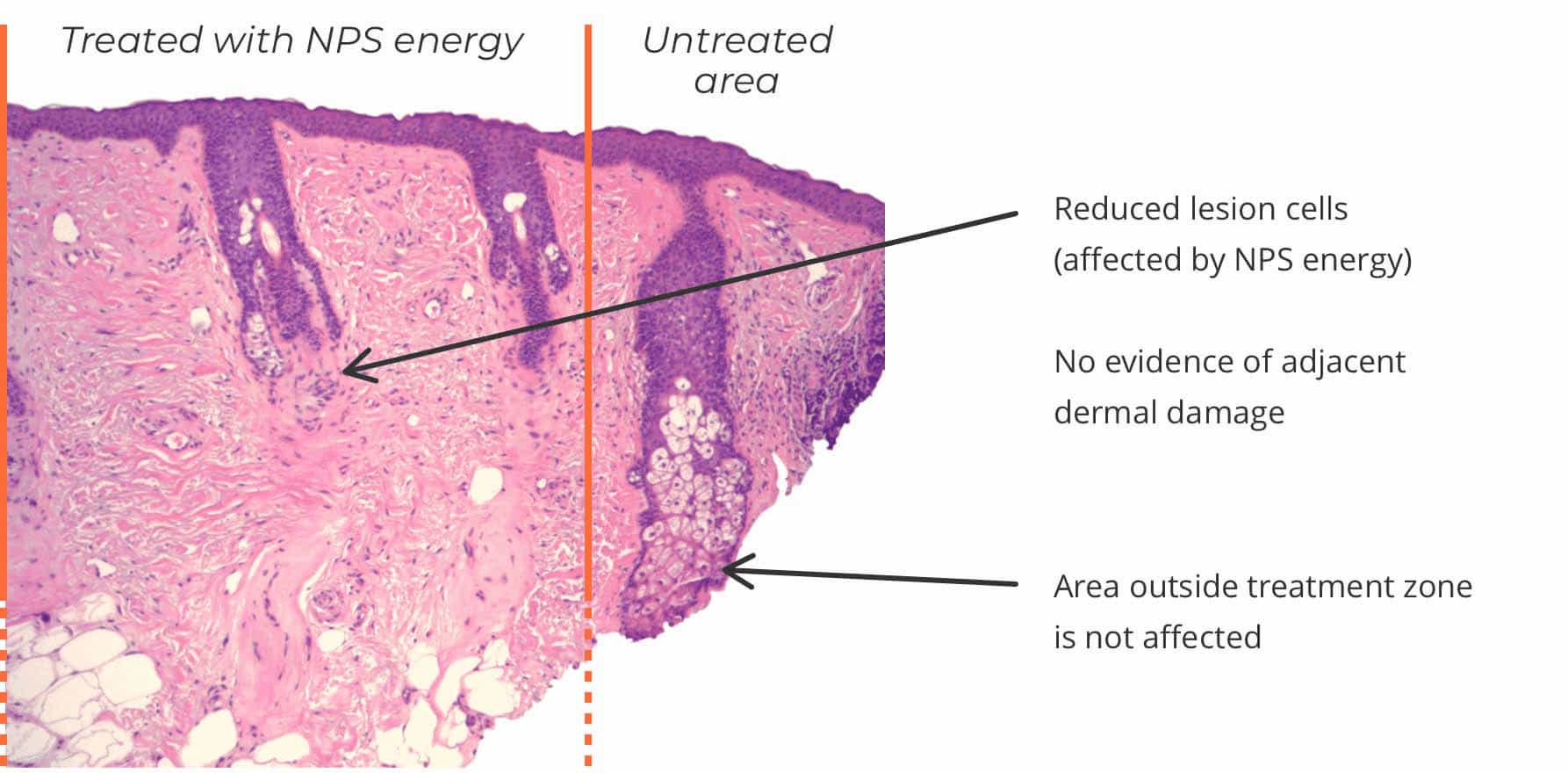 Treatment Zone